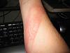 Cadillac logo on my arm after accident!-img_0077-%5B320x200%5D.jpg